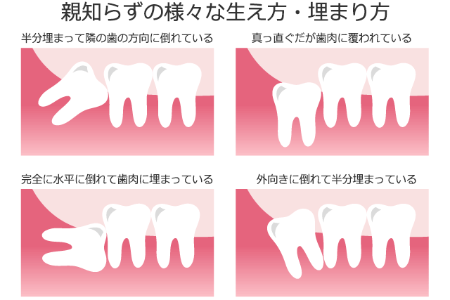 親知らずの生え方引用画像