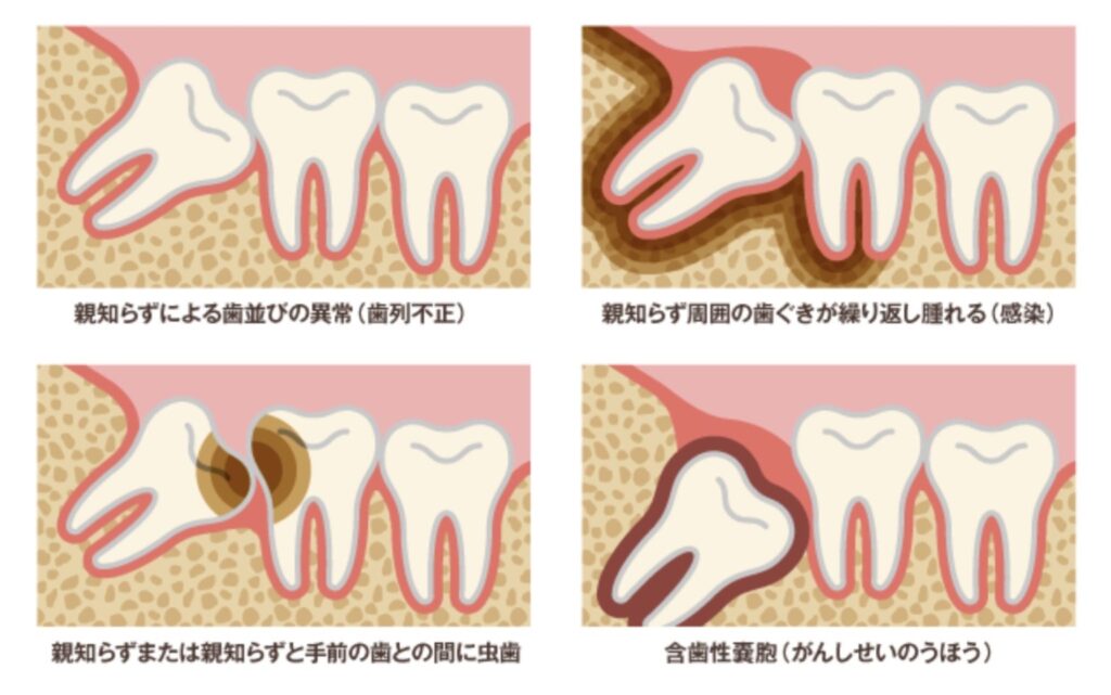 親知らずの問題点引用画像