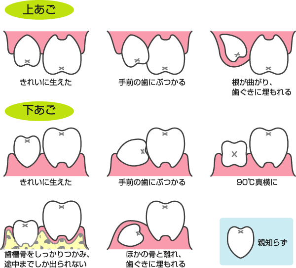 親知らずの種類引用画像