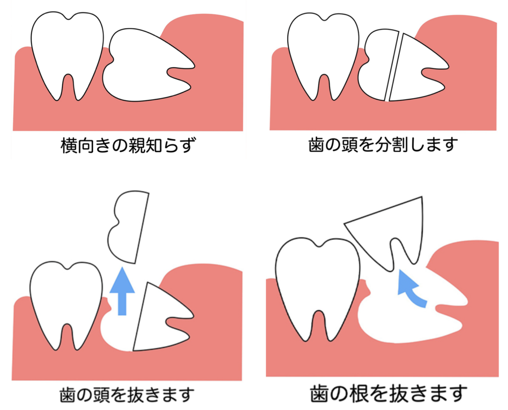 親知らずの抜歯について引用画像